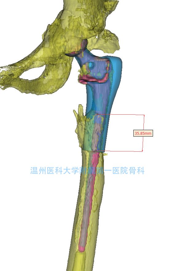 骨科影像迈向智能化时代，凯利泰助力精准诊疗